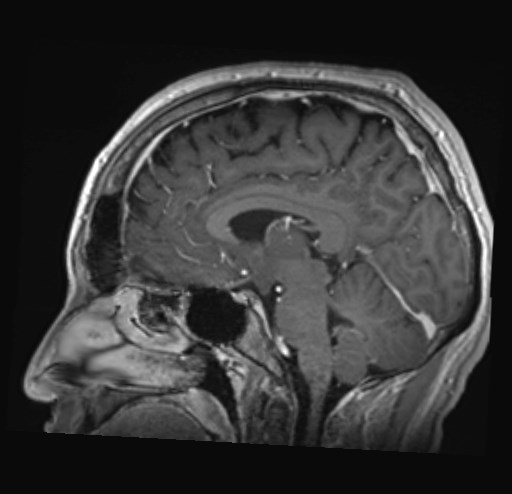 Cochlear incomplete partition type III associated with hypothalamic hamartoma (Radiopaedia 88756-105498 Sagittal T1 C+ 26).jpg