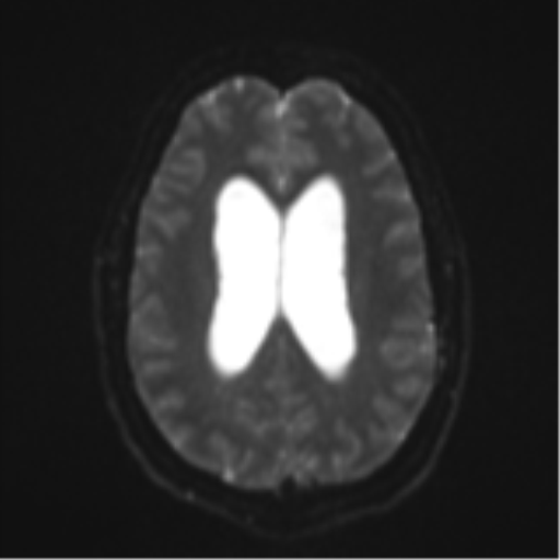 File:Colloid cyst (Radiopaedia 44510-48181 Axial DWI 19).png