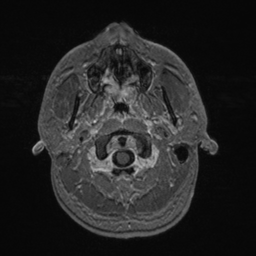 File:Colloid cyst (Radiopaedia 44510-48181 Axial T1 C+ 20).png