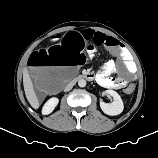 Colocolic intussusception due to large lipoma (Radiopaedia 68773-78482 A 79).jpg