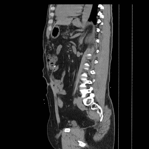 File:Colocutaneous fistula in Crohn's disease (Radiopaedia 29586-30093 C 33).jpg