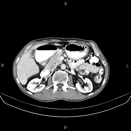 Colon adenocarcinoma - hepatic flexure (Radiopaedia 85635-101395 A 32).jpg