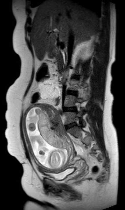 Colon adenocarcinoma with Krukenberg tumors, advanced pregnancy (Radiopaedia 67279-76645 Sagittal T2 30).jpg