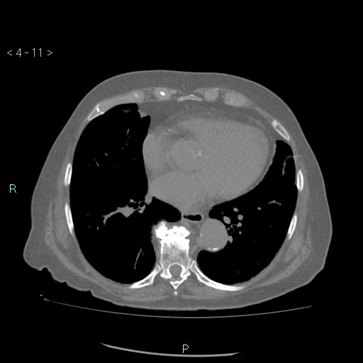 Colonic lipomas (Radiopaedia 49137-54244 Axial bone window 5).jpg