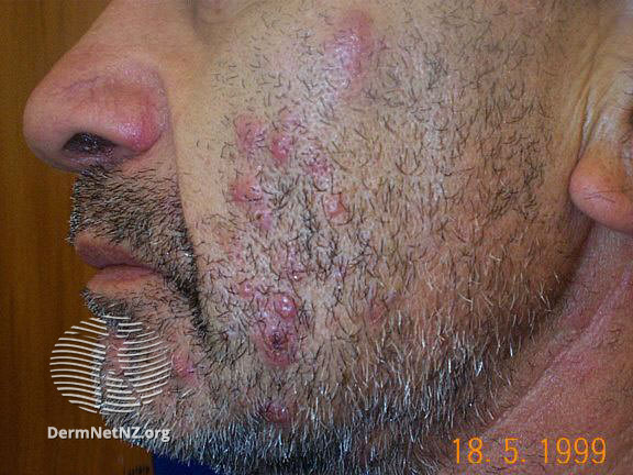 File:Inflammatory lesions (DermNet NZ acne-chloracne1).jpg