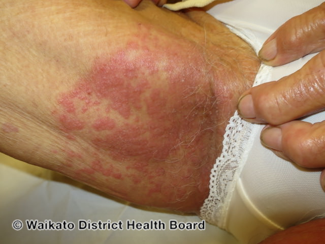 File:Intertrigo due to candida infection (DermNet NZ dermatitis-w-candida-046).jpg