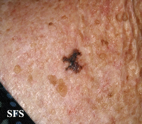 File:Melanoma (Dermatology Atlas 25).jpg