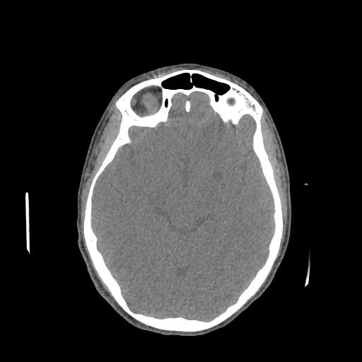 Nasal pyogenic granuloma (lobular capillary hemangioma) (Radiopaedia 85536-101244 Axial non-contrast 125).jpg