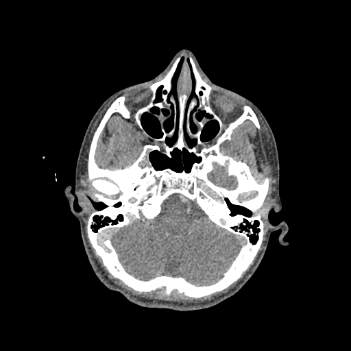 Nasal pyogenic granuloma (lobular capillary hemangioma) (Radiopaedia 85536-101244 C 88).jpg