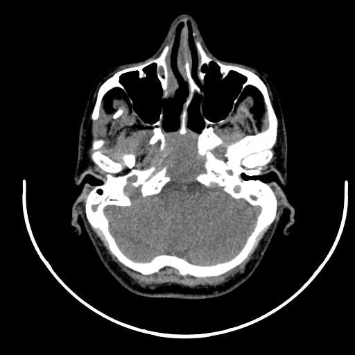 Nasopharyngeal carcinoma - infiltrating the clivus (Radiopaedia 62583-70875 Axial non-contrast 12).jpg