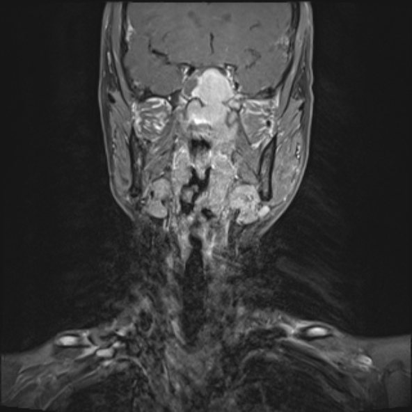 Nasopharyngeal carcinoma with skull base invasion (Radiopaedia 53415-59485 E 23).jpg