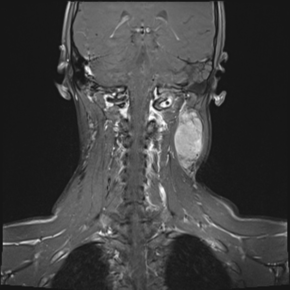 Nasopharyngeal carcinoma with skull base invasion (Radiopaedia 53415-59485 E 7).jpg