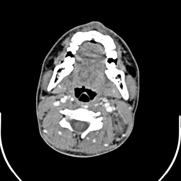 Nasopharyngeal carcinoma with skull base invasion (Radiopaedia 53415-59705 A 105).jpg