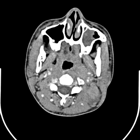 Nasopharyngeal carcinoma with skull base invasion (Radiopaedia 53415-59705 A 73).jpg