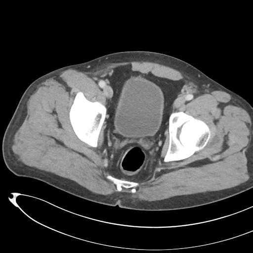 File:Necrotizing pancreatitis with acute necrotic collections (Radiopaedia 38829-41012 B 77).png