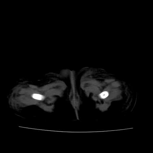 File:Neuroblastoma (Radiopaedia 20876-20799 Axial non-contrast 27).jpg