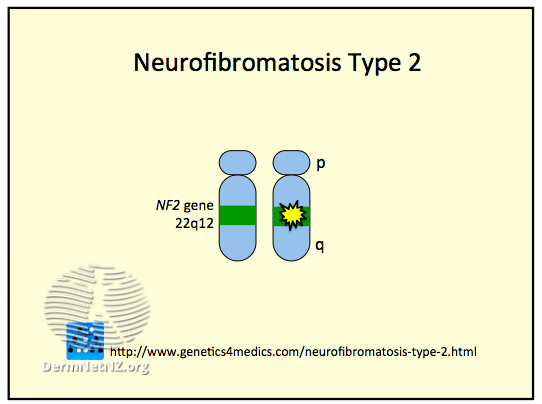 File:Neurofibromatosis Type 2 (DermNet NZ Neurofibromatosis-Type-2).png