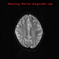 File:Neurofibromatosis type 1 with optic nerve glioma (Radiopaedia 16288-15965 Axial DWI 7).jpg