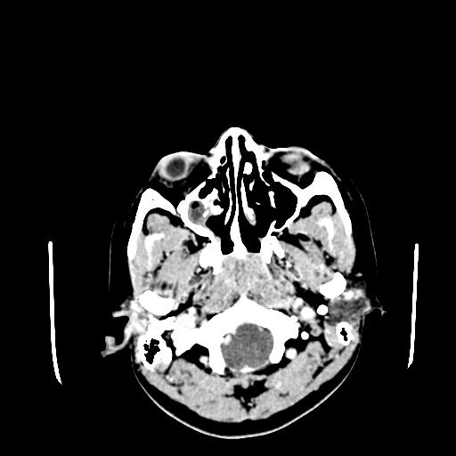 File:Neurofibromatosis type 2 (Radiopaedia 25389-25637 Axial C+ 4).jpg