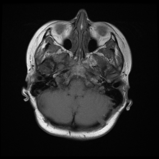 File:Neurofibromatosis type 2 (Radiopaedia 45229-49247 Axial T1 5).png
