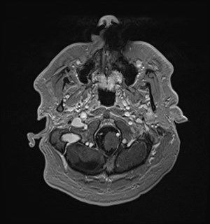 Neurofibromatosis type 2 (Radiopaedia 79097-92049 Axial T1 C+ 32).jpg