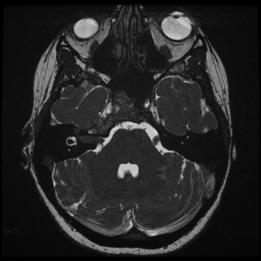 Neurofibromatosis type 2 - bilateral acoustic neuromata (Radiopaedia 40060-42566 Axial FIESTA 45).png