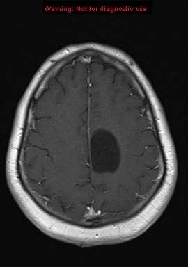 File:Neuroglial cyst (Radiopaedia 10713-11184 Axial T1 C+ 6).jpg