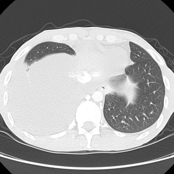 File:Non-Hodgkin lymphoma involving lung (Radiopaedia 29094-29470 Axial lung window 57).jpg