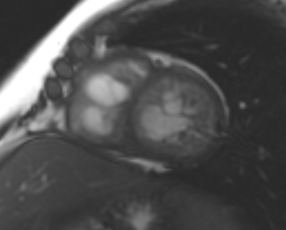File:Non-compaction of the left ventricle (Radiopaedia 69436-79314 Short axis cine 103).jpg