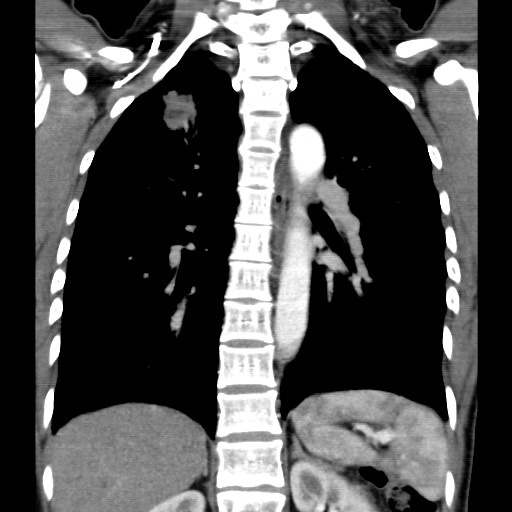 File:Non-small cell lung cancer with miliary metastases (Radiopaedia 23995-24193 B 13).jpg