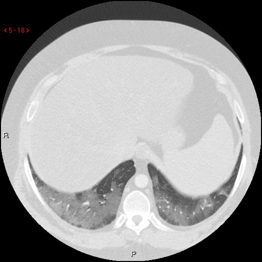 File:Non-specific interstitial pneumonitis (Radiopaedia 27044-27222 Axial lung window 9).jpg