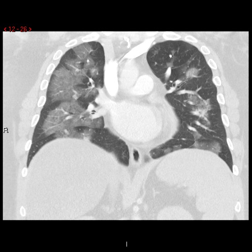 File:Non-specific interstitial pneumonitis (Radiopaedia 27044-27222 Coronal lung window 26).jpg