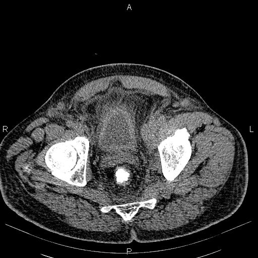 File:Non Hodgkin lymphoma in a patient with ankylosing spondylitis (Radiopaedia 84323-99621 Axial non-contrast 57).jpg