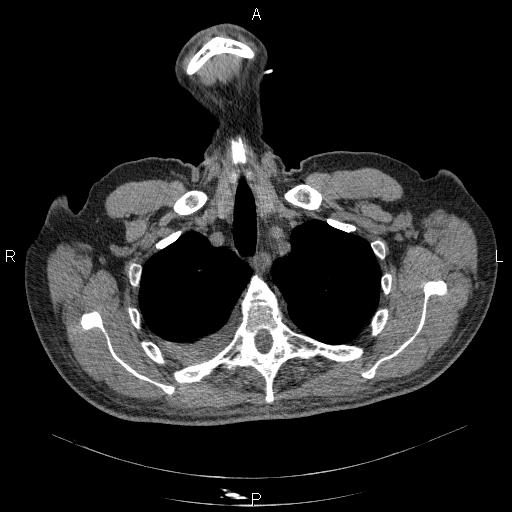 File:Non Hodgkin lymphoma in a patient with ankylosing spondylitis (Radiopaedia 84323-99624 Axial non-contrast 8).jpg