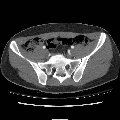 File:Normal CT angiogram of pelvis (Radiopaedia 45390-49430 A 29).jpg