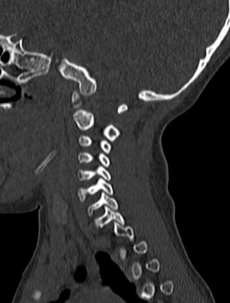 File:Normal CT cervical spine - pediatric (Radiopaedia 52549-58462 Sagittal bone window 150).jpg