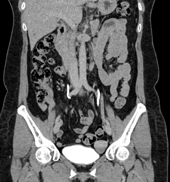 Normal CT intravenous urogram (Radiopaedia 39444-41759 A 253).jpg