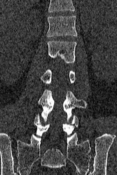 Normal CT lumbar spine (Radiopaedia 53981-60118 Coronal bone window 37).jpg