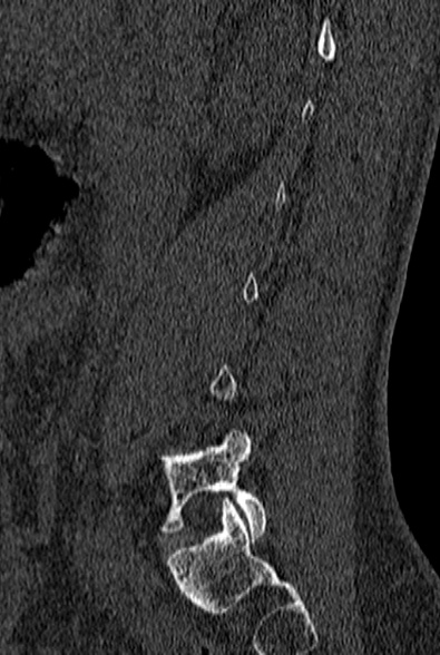 File:Normal CT lumbar spine (Radiopaedia 53981-60118 Sagittal bone window 20).jpg