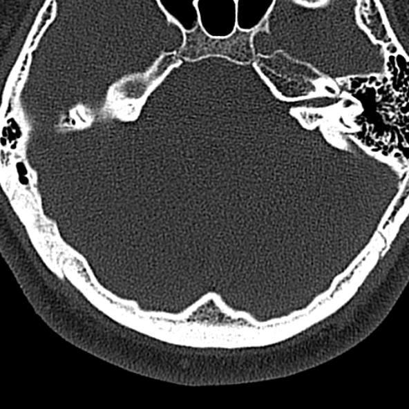 File:Normal CT of the cervical spine (Radiopaedia 53322-59305 Axial bone window 1).jpg