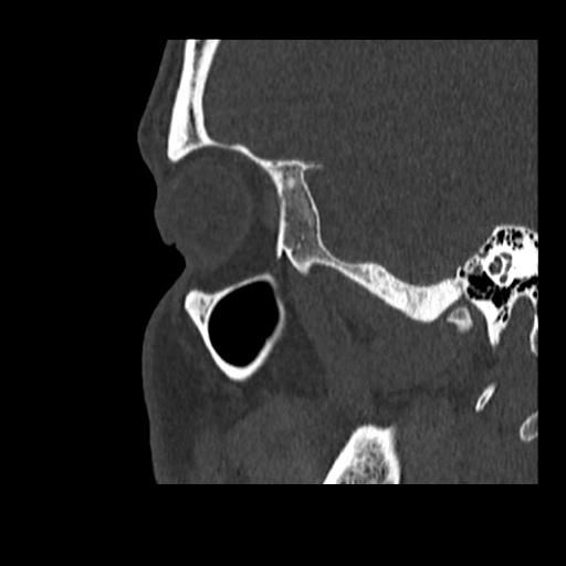 Normal CT paranasal sinuses (Radiopaedia 42286-45390 Sagittal bone window 15).jpg