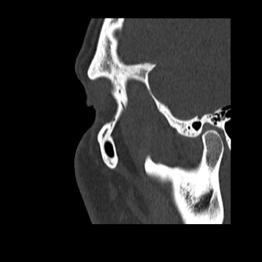 Normal CT paranasal sinuses (Radiopaedia 42286-45390 Sagittal bone window 96).jpg