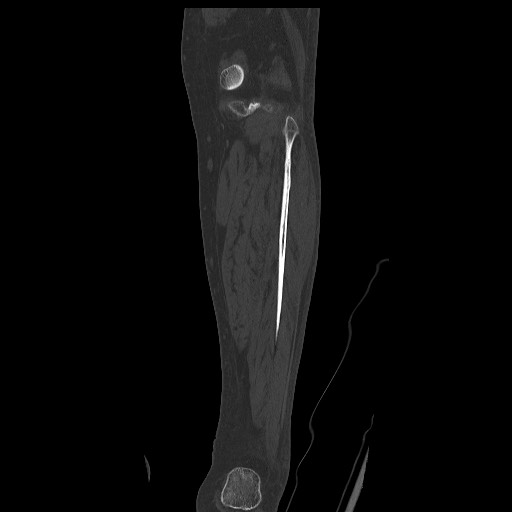Normal CT tibia and fibula (Radiopaedia 51195-56848 Coronal non-contrast 47).jpg