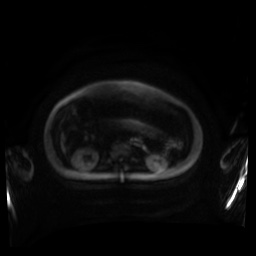 Normal MRI abdomen in pregnancy (Radiopaedia 88001-104541 Axial DWI 115).jpg