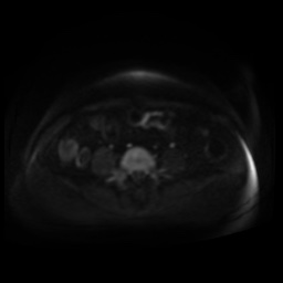 Normal MRI abdomen in pregnancy (Radiopaedia 88005-104548 Axial DWI 106).jpg