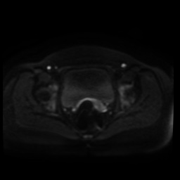 Normal MRI abdomen in pregnancy (Radiopaedia 88005-104548 Axial DWI 86).jpg