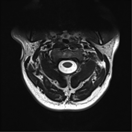 File:Normal MRI cervical spine (infection protocol) (Radiopaedia 53916-60039 Axial T2 13).png