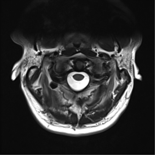 File:Normal MRI cervical spine (infection protocol) (Radiopaedia 53916-60039 Axial T2 9).png
