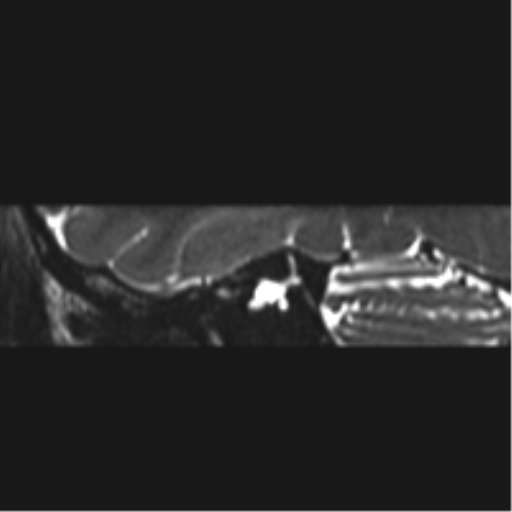 Normal MRI internal auditory canal (Radiopaedia 41613-44525 C 20).png