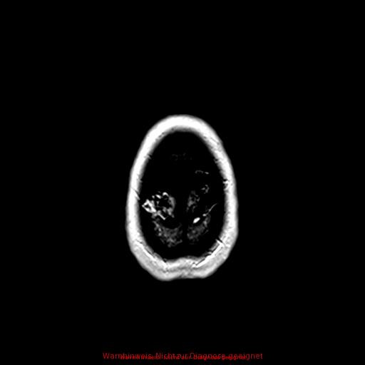 Normal adult brain MRI (non-enhanced and contrast-enhanced) (Radiopaedia 75262-86379 Axial T1 C+ 174).jpg